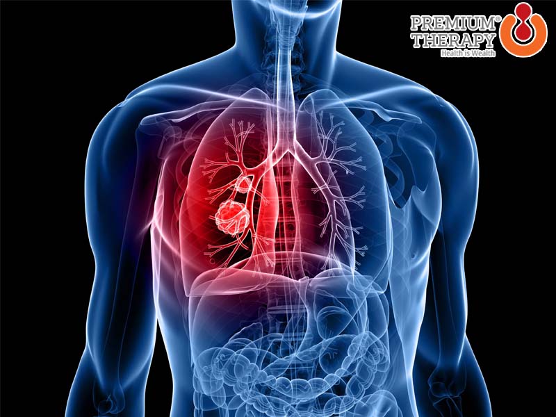 Các dấu hiệu ung thư phổi mà bạn cần phải biết