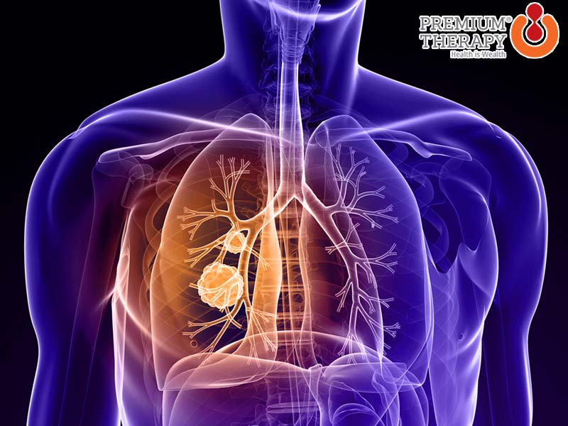 Ung thư phổi có lây không? Cách phòng ngừa ung thư phổi
