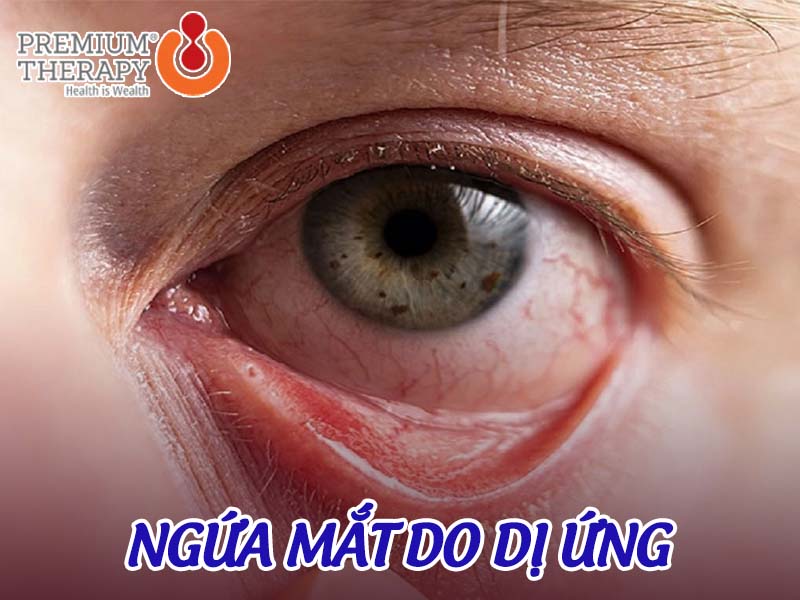 Những nguyên nhân gây ngứa mắt và cách điều trị